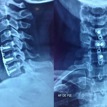 Paciente femenino de 53 años con dos hernias de disco cervicales, se instrumentó con caja-placa en dos niveles.