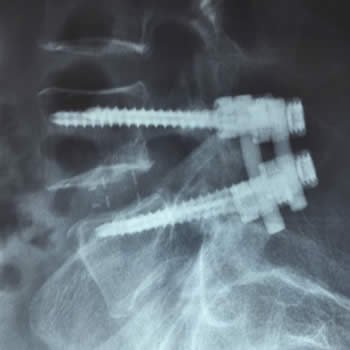 Paciente femenino de 62 años con canal lumbar estrecho secundario a inestabilidad L4-L5, se realiza instrumentación con tornillos y caja a través de vía mínimamente invasiva.