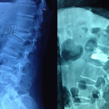 Paciente masculino de 70 años con fractura de vértebra por osteoporosis en la cual se realiza Xifoplastia por técnica mínimamente invasiva.