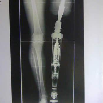 Reconstrucción de amputación de pierna con técnica de osteointegración
