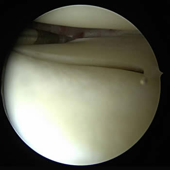 Artroscopia de rodilla (meniscos sanos)