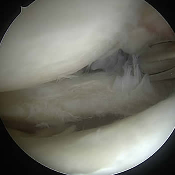 Artroscopia de rodilla para reconstrucción de meniscos