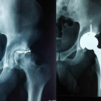 Prótesis de cadera secundario a osteoartritis postraumática por fractura