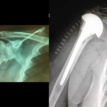 Prótesis parcial de hombro por pérdida masiva del mango rotador