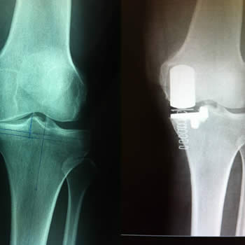 Reemplazo parcial de rodilla por osteoartritis de compartimiento interno